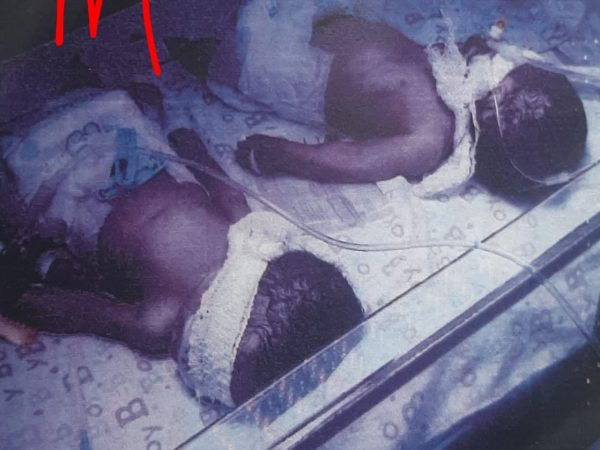 Police Reveals Cause of Death of Twin Babies in Edo
