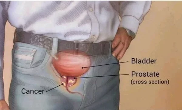 Five Early Warning Signs Of An Enlarged Prostate That Every Man Need To Know